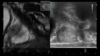 Biopsia de próstata mediante fusión con RNM multiparamétrica [upl. by Landmeier]