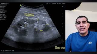 DOLOR DE ESPALDA 😣 LITIASIS RENAL MÚLTIPLES INFECCIONES URINARIAS DIABETES DESCONTROLADA [upl. by Gerlac]