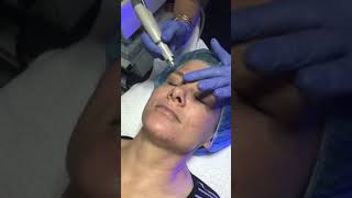 HydraFacial Treatment  Perk Eyes [upl. by Kwapong]