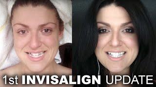 My Invisalign Experience  Vlog 25 [upl. by Arel]