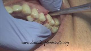 How to use luxator and forceps to remove upper decayed first molar [upl. by Munshi302]