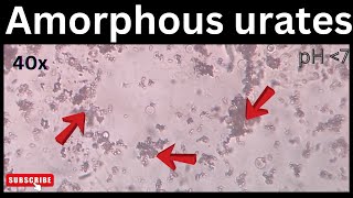 Amorphous urates in urine  medicallabtechnologysajal6903 [upl. by Kam]