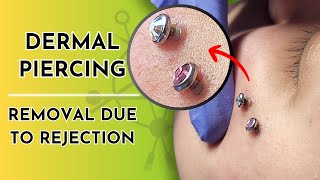 Dermal Piercings  Removal Due to Rejection 💎❌ [upl. by Thayer477]