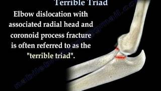 Elbow Fracture Dislocation Terrible Triad  Everything You Need To Know  Dr Nabil Ebraheim [upl. by Goldshell]