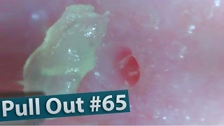 65 Pull Out Blackheads Close Up 200X  Blackheads Removal [upl. by Sheila276]