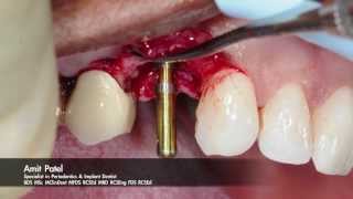 Onestage surgery using Tapered Internal PLUS dental implant from BioHorizons [upl. by Ashraf757]