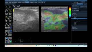 IQ 252 LIVER HEPATOMA ULTRASOUND ELASTOGRAPHY ECHOPAC ANALYSIS [upl. by Vharat]