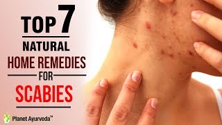 Top 7 Natural Home Remedies for Scabies [upl. by Thrasher]