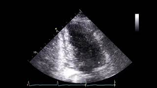 How to Assess Systolic Function with Echocardiography in Patients with HCM [upl. by Nilrac950]