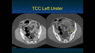 Transitional Cell Carcinoma of the Kidneys 2022 Pearls and Pitfalls  Part 3 [upl. by Ennyl]