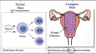 Molar pregnancy partial and complete hydatidiform mole  USMLE Step 1 [upl. by Lemrac600]