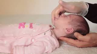 HOW WE FIXED INFANT TONGUE TIE and MOUTH MUSCLE CONTRACTURES causing BREASFEEDING PROBLEMS [upl. by Ahsenak]