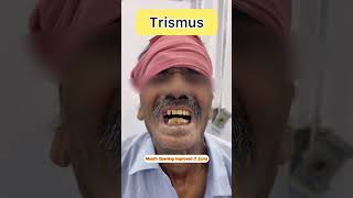 Trismus Treatment shorts trismus mouthcancer [upl. by West]