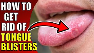 How to Get Rid of Tongue BlistersCanker Sores TOP TEN REMEDIES FOR TONGUE ULCERS [upl. by Sukcirdor]