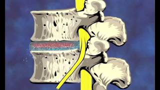 Diskushernie Teil 1 Intro  Belastungen  Hernien Typen [upl. by Reeve28]