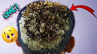 OMG Lots of Tiny Worms On Dandruff Removal 1151 [upl. by Yelad111]