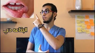 علاج قرح الفم  Aphthous Ulcers [upl. by Aicemaj]