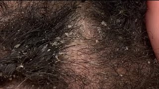 Dandruff Picking and Scratching  Flaky Eczema Scalp extreme close up ASMR [upl. by Leahcir]