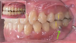 Non Extraction Treatment of CIII Malocclusion with invisalign｜【Chris Chang Ortho】CC677 [upl. by Nerta]