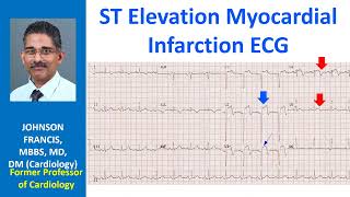 ST Elevation Myocardial Infarction ECG [upl. by Wendelin]