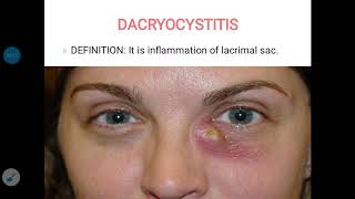 Dacryocystitis [upl. by Junette]