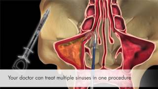 Balloon Sinus Dilation from Entellus [upl. by Cone]