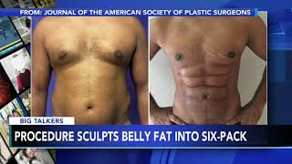 New procedure uses foam to sculpt belly fat into 6pack abs [upl. by Ettenna]