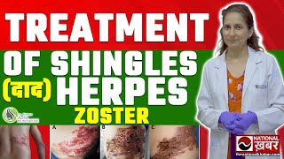 Shingles Herpes Zoster Pathophysiology Risk Factors Phases of Infection Symptoms Treatment [upl. by Ised]