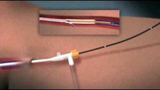 Animation of Endovenous Radiofrequency Ablation of Varicose Vein [upl. by Gaylene497]