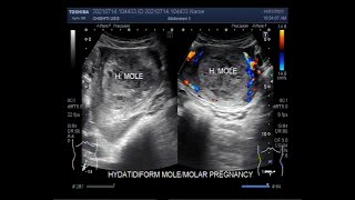 Complete Hydatidiform Mole also called Molar Pregnancy [upl. by Atinehc]