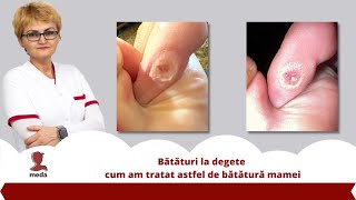 Bataturi la degete 👉 cum am tratat astfel de batatura mamei [upl. by Assiral]