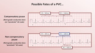 Advanced EKGs  PACs and PVCs ie premature beats [upl. by Apoor]