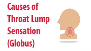 Causes of Throat Lump Sensation Globus [upl. by Rosen]