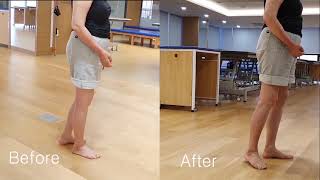 CASE 뇌출혈 편마비 Mrs Park Exercise for hemiplegia  beforeafter 편마비 운동 전후 보행 비교 [upl. by Butler]