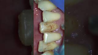 Scaling and Air Polishing using Prophymate teeth teethcleaning teethwhitening satisfying [upl. by Ejrog372]