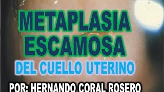 METAPLASIA ESCAMOSA DEL CUELLO UTERINO [upl. by Bixby]