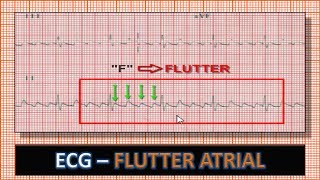 ECG  Eletrocardiograma com Flutter Atrial [upl. by Nalac]