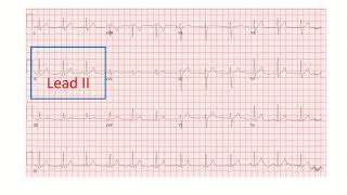 Corrected QT interval QTc on electrocardiogram part 2 [upl. by Bryon]