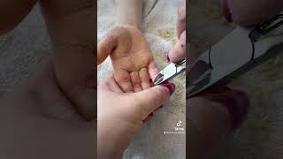 Removing callus from kid hands  Keratoderma hyperkeratosis EPPK skin shaving callous  Mar 30 2023 [upl. by Lenni]