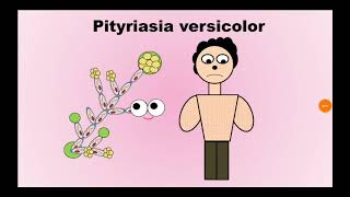 2 Pityriasis versicolor السعفة المبرقشة Malassezia furfur [upl. by Uriah577]