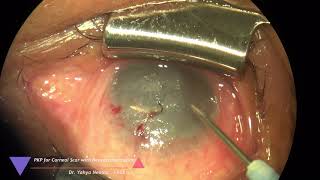 PKP for corneal scar with neovascularization [upl. by Cecilla]