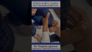 Clubfoot can correctable ll clubfoottreatment clubfoot treatment Congenital Talipes Equinovarus [upl. by Naldo]