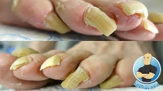 LONG TOENAILS FOR DAYS  TOENAIL CUTTING PART 1 [upl. by Neik]