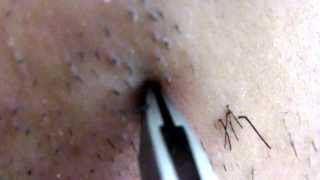 Ingrown Hair！ [upl. by Bourke]