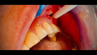 Incise and drain of a severe dental abscess Pus [upl. by Oyek]