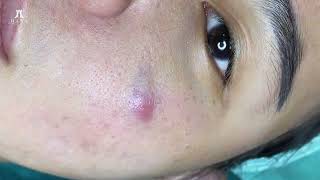 Big Cystic Acne Blackheads Extraction Blackheads amp Milia Whiteheads Removal Pimple Popping [upl. by Asiulana379]