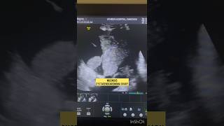 Ovarian cancer  Mucinous cystadenoCarcinoma  ultrasound cancer [upl. by Domonic457]