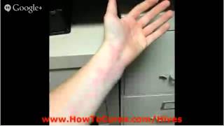 Urticaria Pigmentosa  Cures For Soothing Urticaria  Urticaria Pigmentosa [upl. by Max]