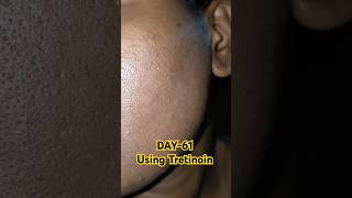 Day 61 Using Tretinoin 0025 tretinoin skincare shorts viralvideos youtubeshorts [upl. by Quintina]