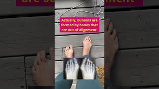 Correct your bunion bunions foothealth bunionrehab [upl. by Rauscher]